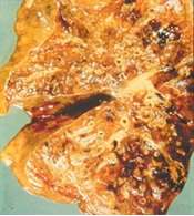 Lungs with Cystic Fibrosis