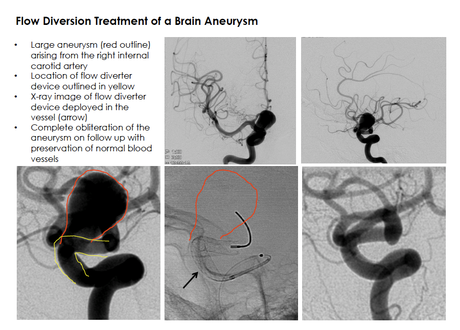 Flow Diversion Treatment of a Brain Aneurysm