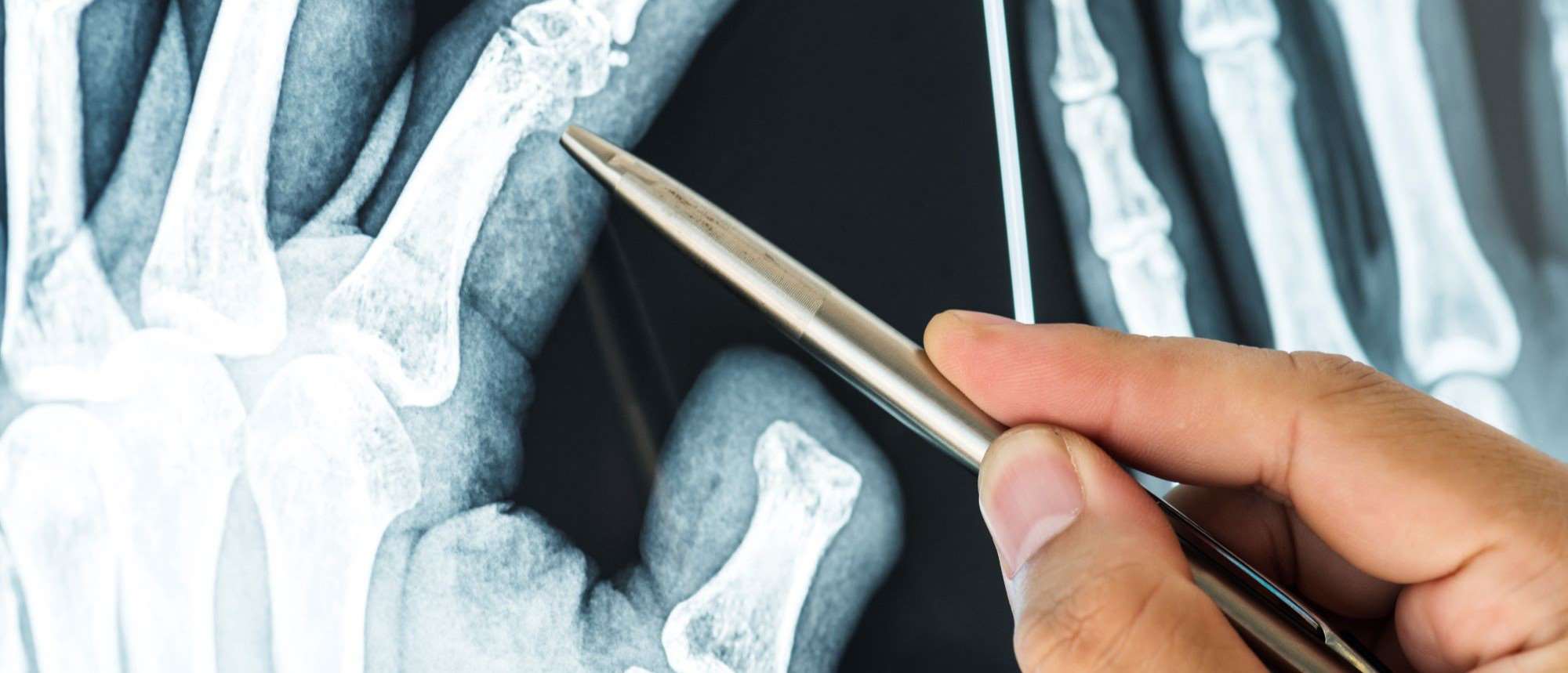 X-ray of hands