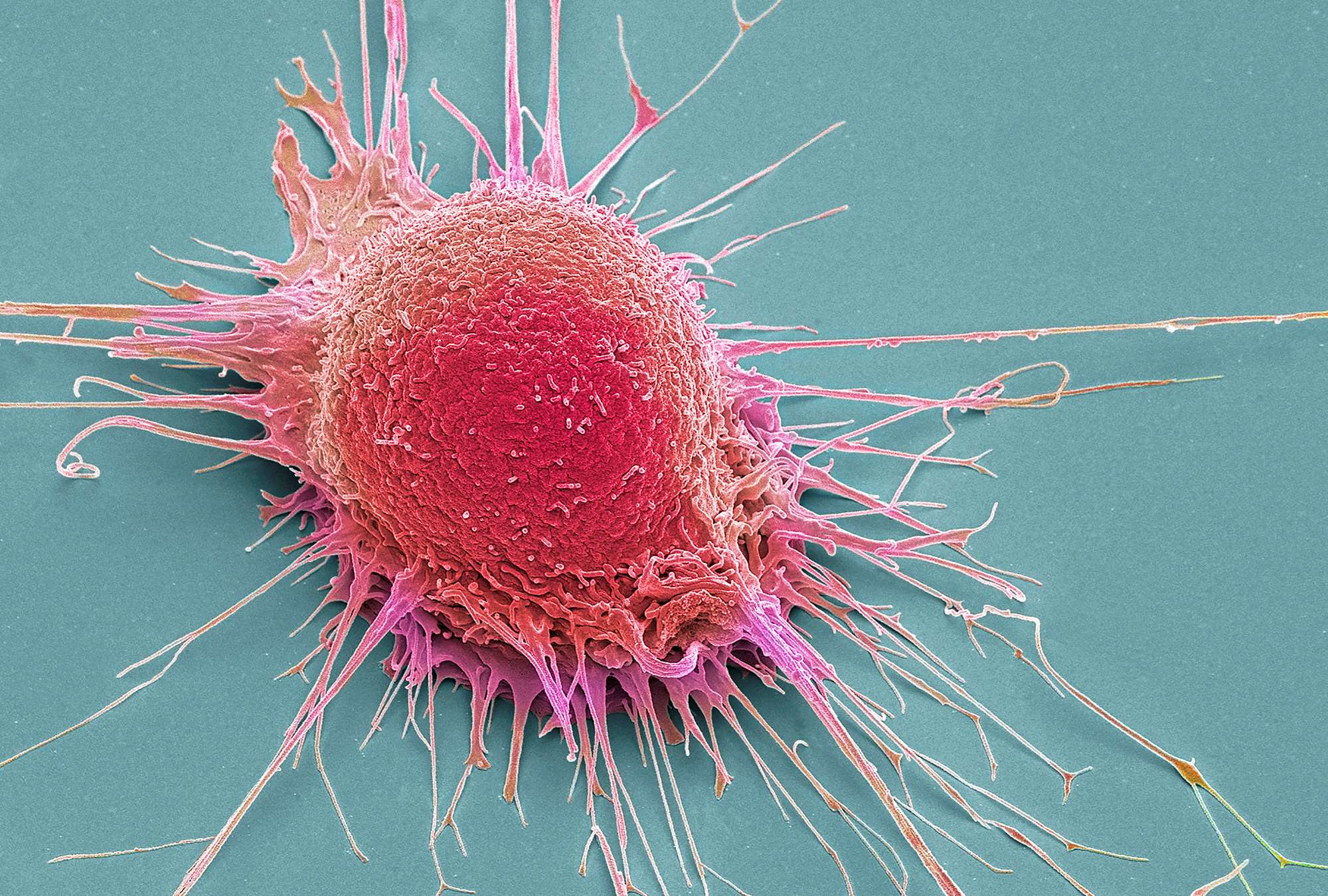  Prostate cancer cell