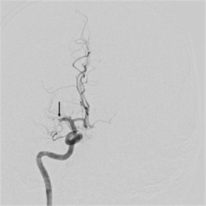 Angiogram shows complete occlusion of the right middle cerebral artery (arrow).