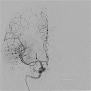 Recanalization of the right middle cerebral artery (arrow) after clot removal showing normal blood flow.