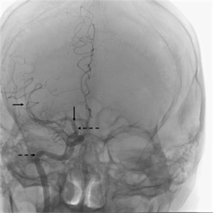 Image of the retrievable stent device deployed in the clot in the right middle cerebral artery. The ends of the stent are marked by arrows. Catheters (plastic tubes) are marked by dashed arrows.