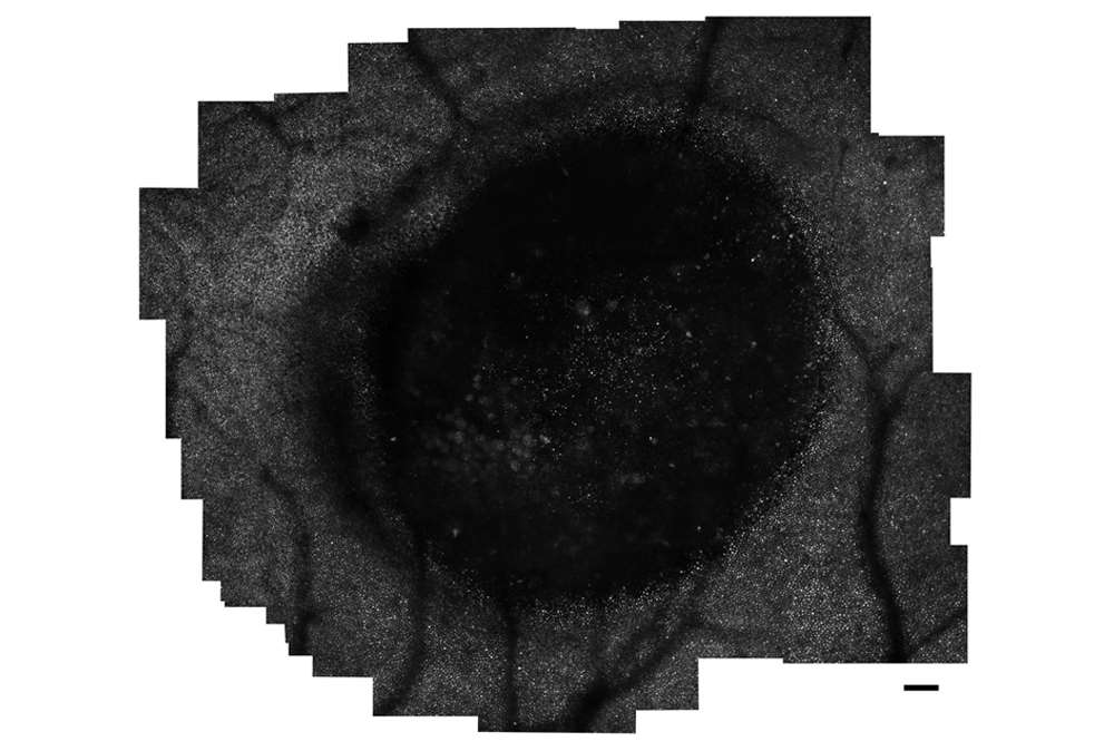 BestsDisease_AOSLO_lesion