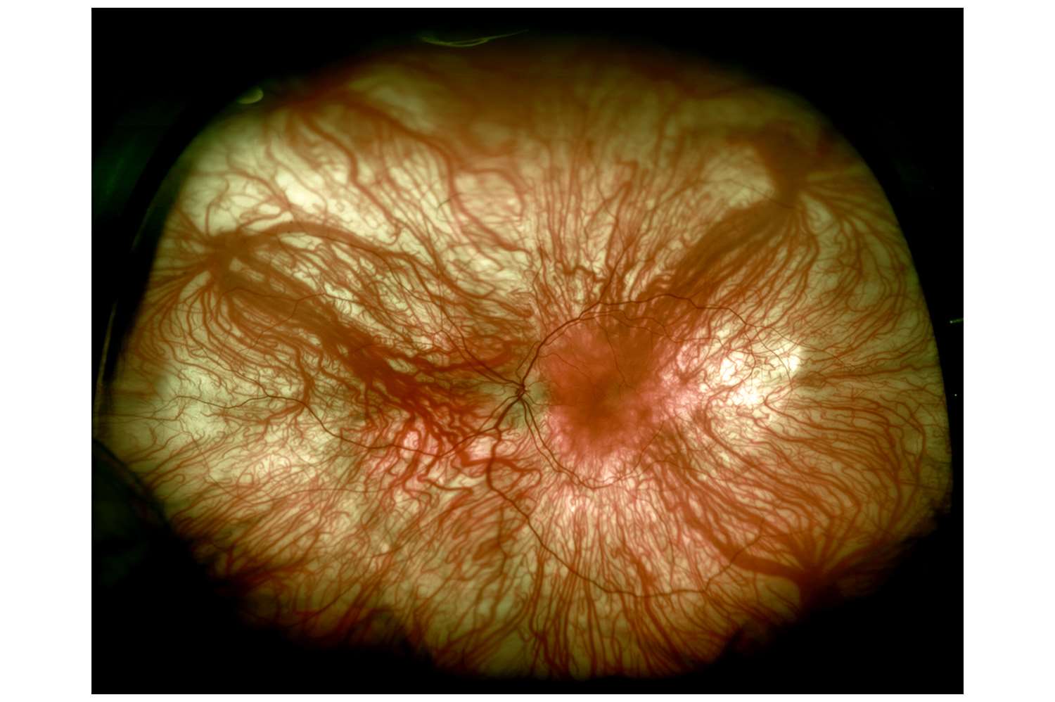 OcularAlbinismOptos1