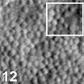 Chen_OphthSci_2025
