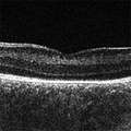 Dubis_2013_Ophthalmol