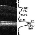 Goldberg_2016_RetinaBriefCaseRep