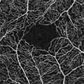 Linderman_2020_IOVS