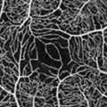 Linderman_OphthalmolRetina_2019