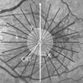 Mathews_2014_IOVS