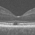 Patterson_2021_OphthRetina