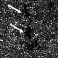 Stepien_2012_ArchOphthalmol