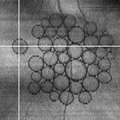 Strampe_2017_RetinalCases