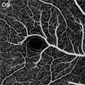 Strampe_AmJOphthalmolCaseRep_2017