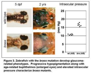 Complex gene interactions underlying glaucoma-phenotypes