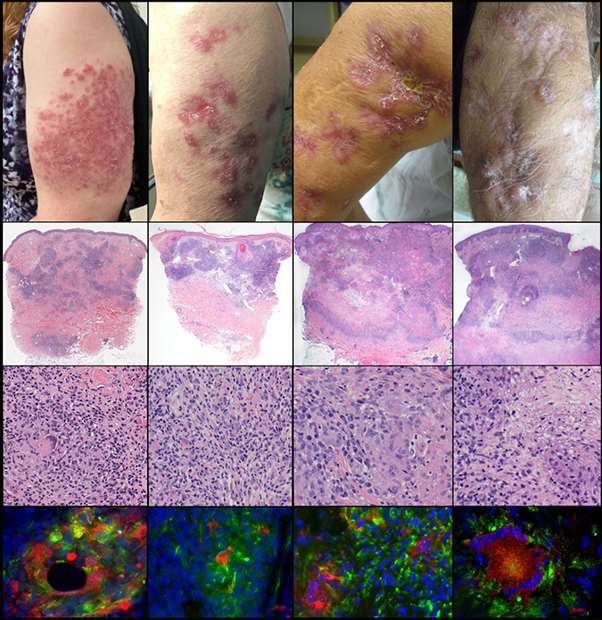 Dermatology Rubella Study image