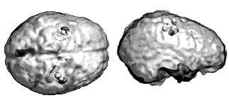 non parametric estimates of confidence intervals on source parameters (the somatotopic cortical representation of hand fingers at 40 ms following hand finger stimulation)