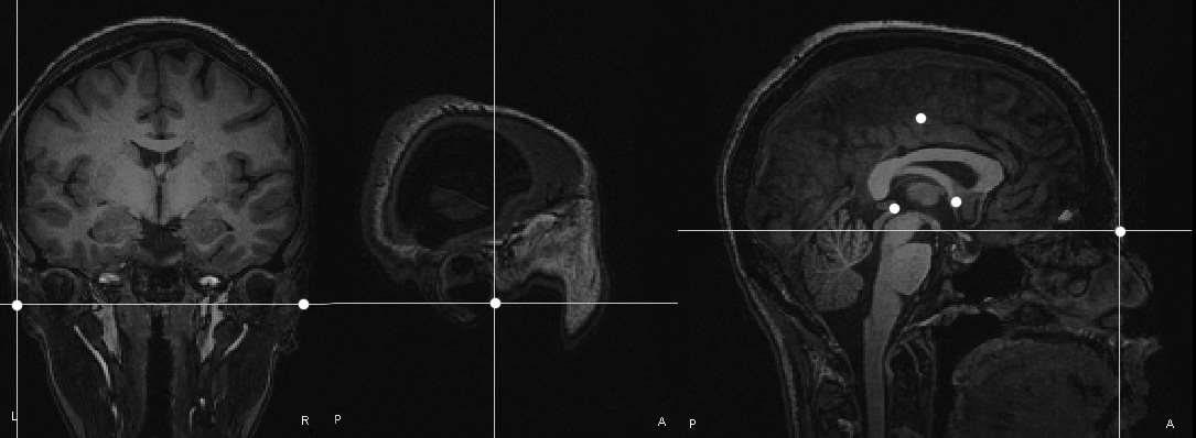 Fiducial points on MRI