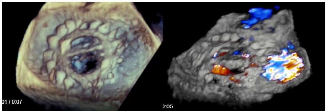 Mechanical Mitral Valve