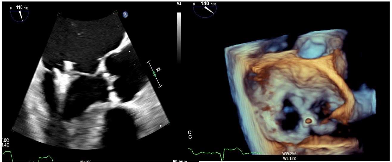 MitraClip Implantation