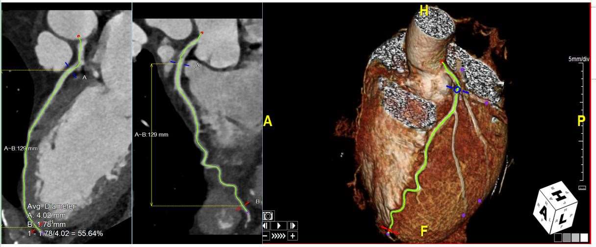 Reconstructed Left Anterior Descending Artery