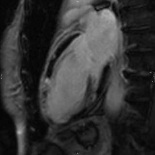 MRI Infarct