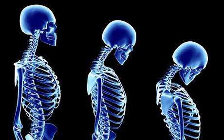 Osteoporosis