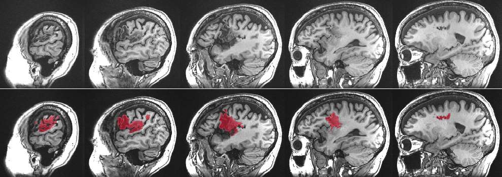 Aphasia Lesion Mapping Figure 1