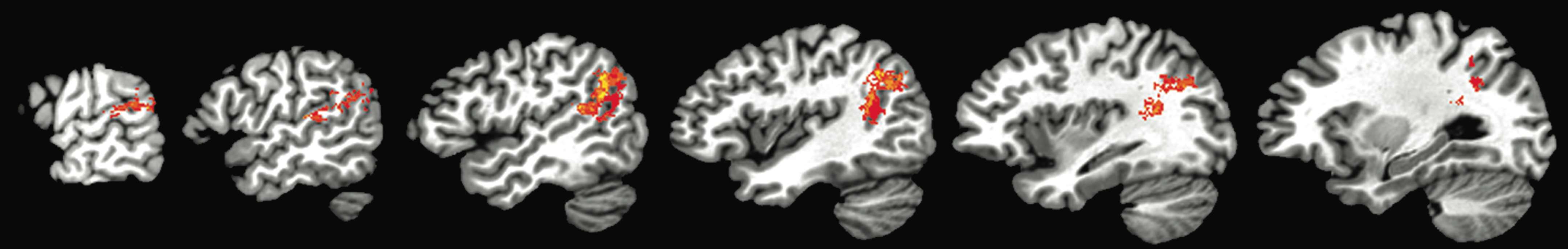 Aphasia VLSM Figure 2