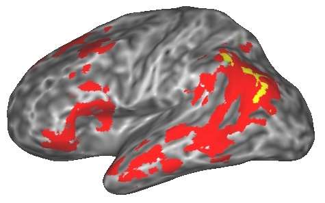 Aphasia fMRI Figure 3