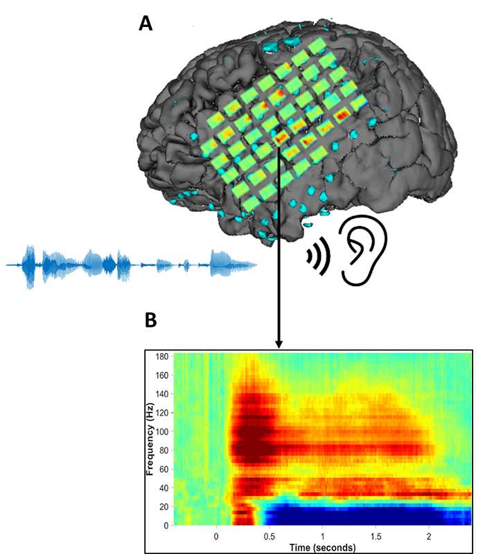 Epilepsy ECoG Method Figure 4