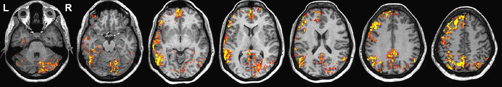 Epilepsy Example fMRI Language Map Figure 1