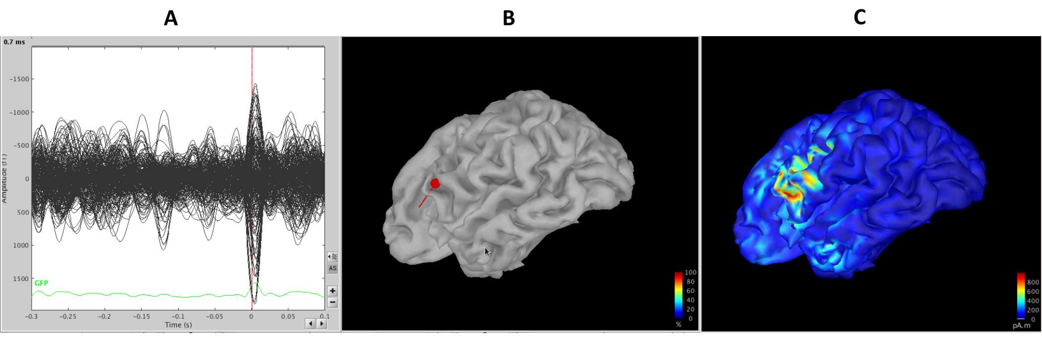 Epilepsy Magnetoencephalography MEG Figure 5