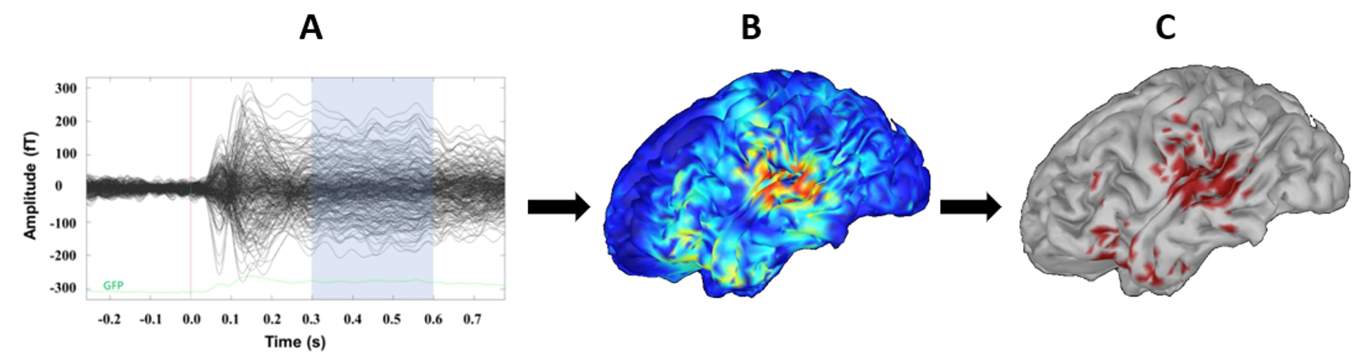Epilepsy Magnetoencephalography MEG Responses to Language Processing Figure 6