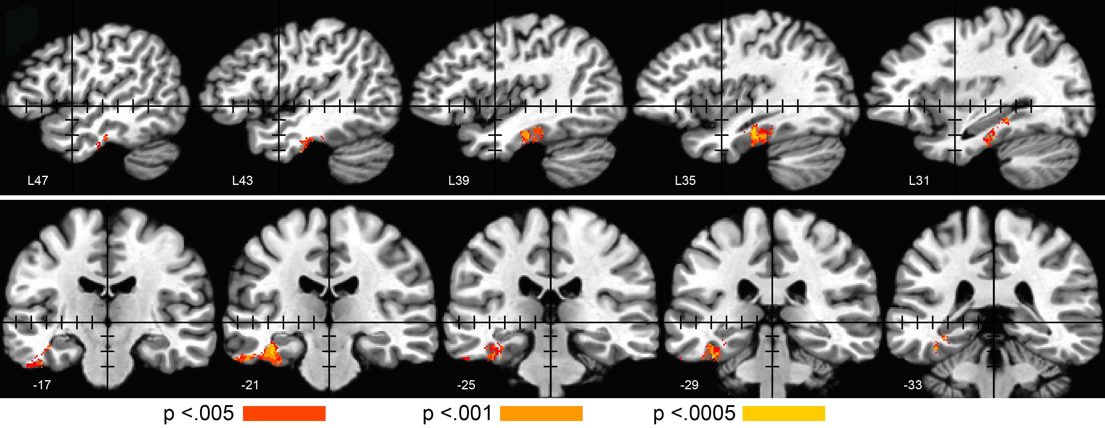 Epilepsy Voxel-based Lesion-symptom Mapping Figure 3