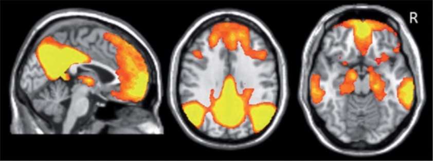 NTRP DMN Brain Activity Figure 2a