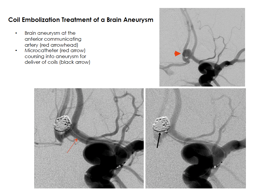 Coil Embolization Treatment of a Brain Aneurysm