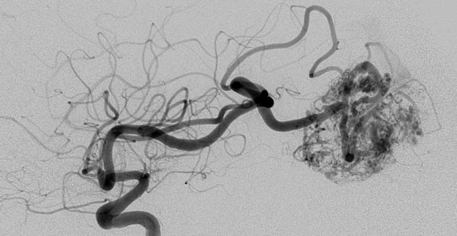 Arteriovenous Malformation (AVM)