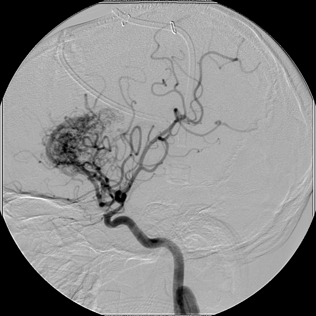 Arteriovenous Malformation (AVM)