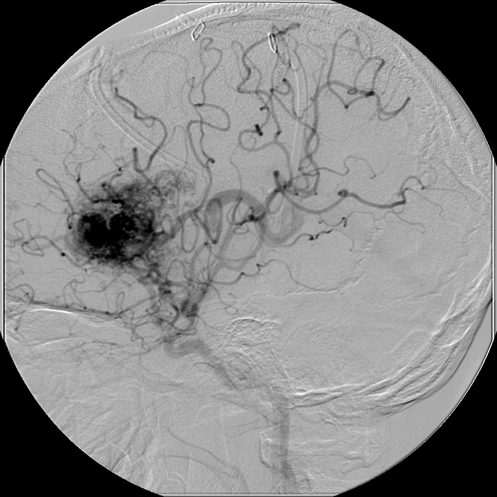 Arteriovenous Malformation (AVM)