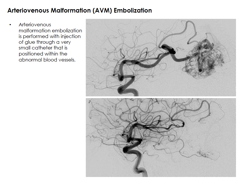 Arteriovenous Malformation (AVM) Embolization