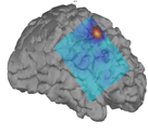 Brain with Epilepsy