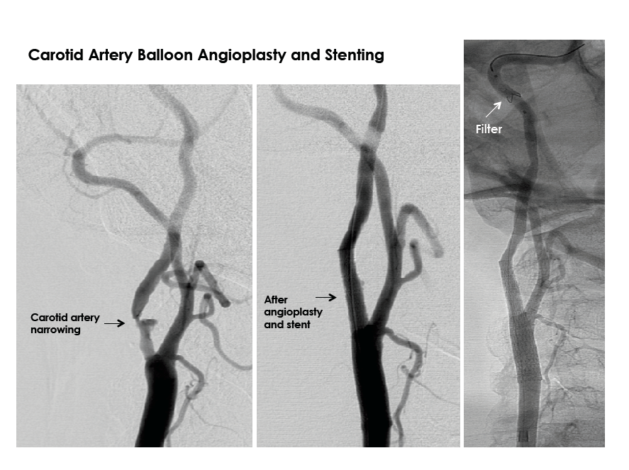Carotid Artery Balloon Angioplasty and Stenting