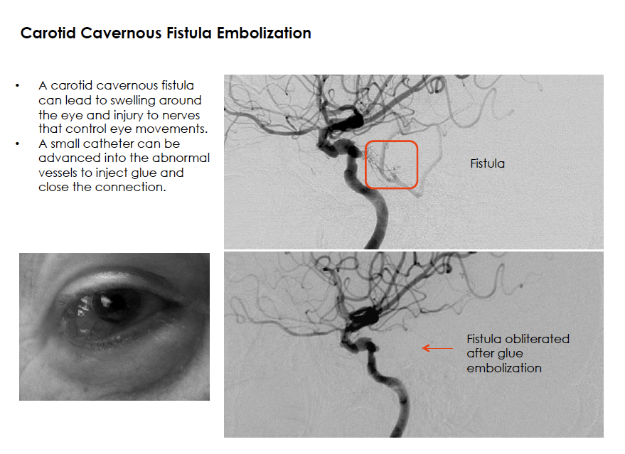 Carotid Cavernous Fistula Embolization