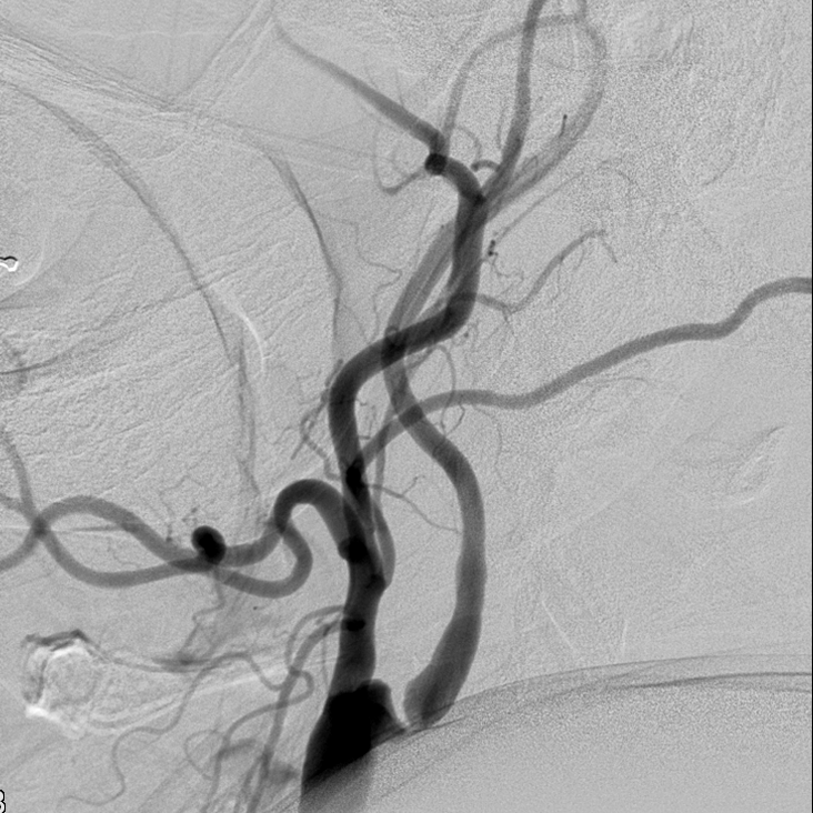 Carotid Artery Stenosis