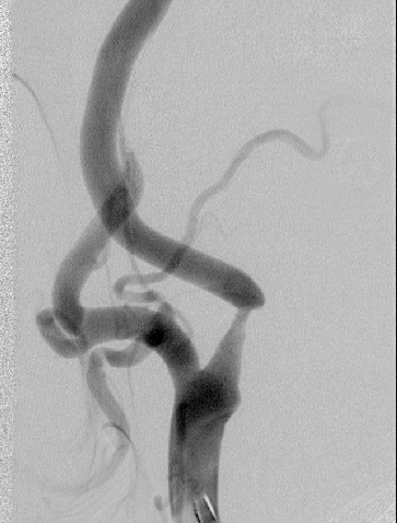 Carotid Artery Stenosis