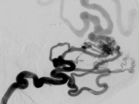 Dural Arteriovenous Fistula (dAVF)