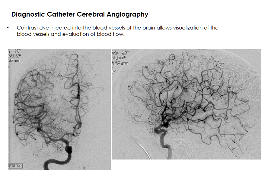 Diagnostic Catheter Cerebral Angiography