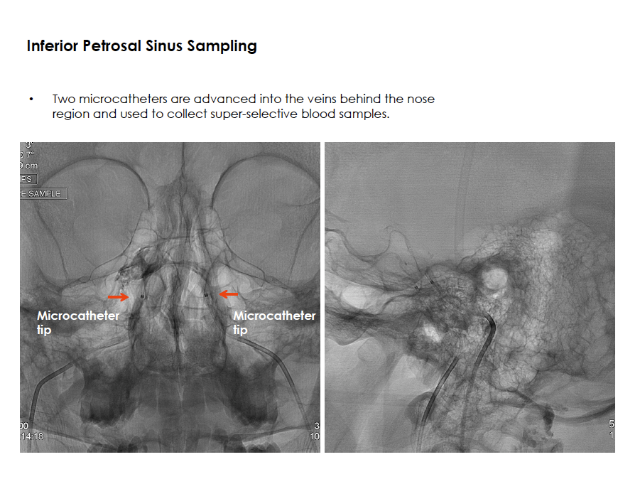 Inferior Petrosal Sinus Sampling